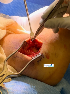Ankle Sprain
