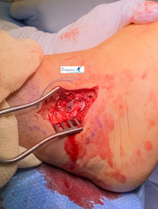 Ankle Sprain