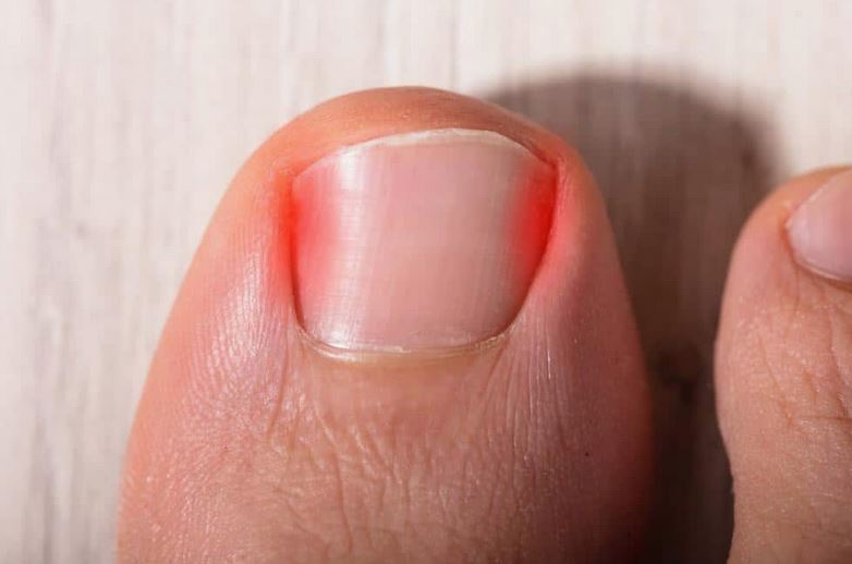 INgrown nail