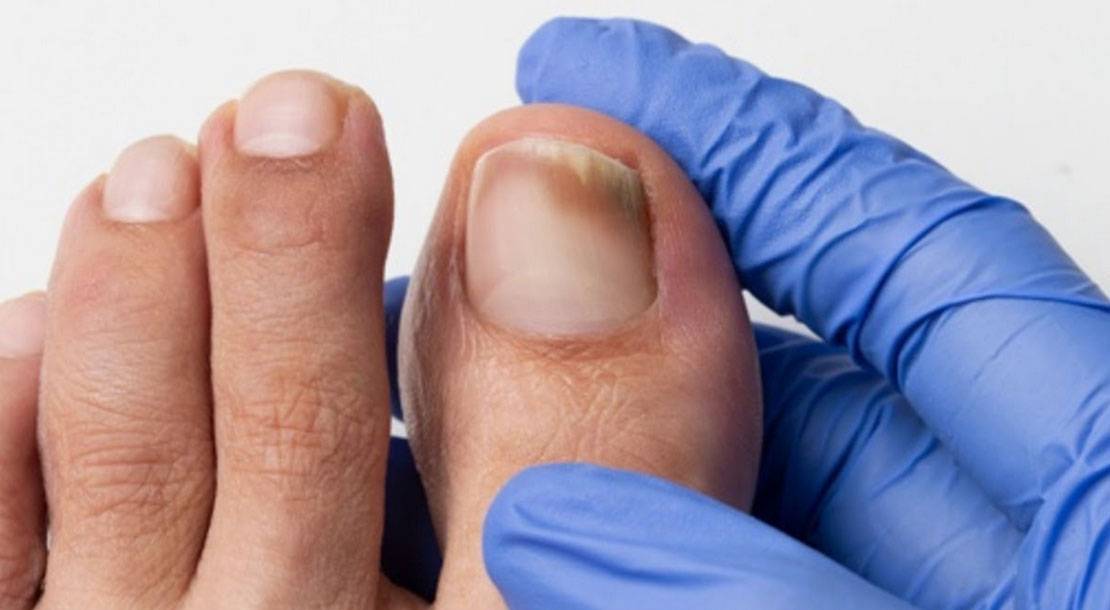 ingrown nail